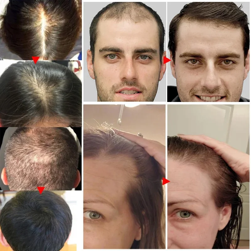 Ginger Hair Growth olio essenz - Hair Care Essential Oil Atomizing recensione e prezzo