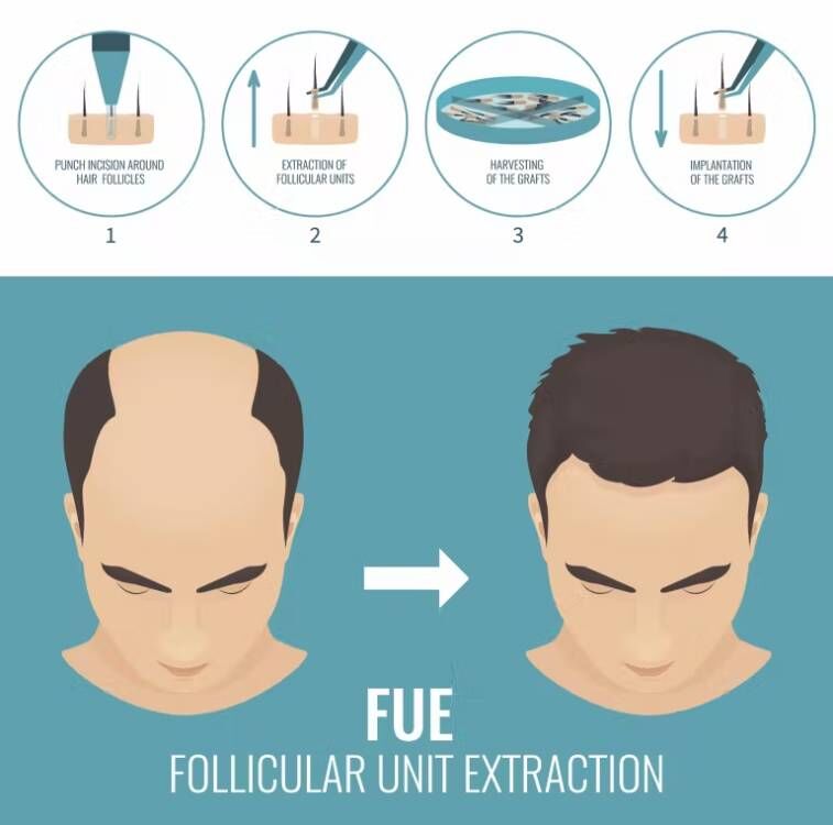 FUE Hair Implant Micro Motor m - Hair Care Vegan recensione e prezzo